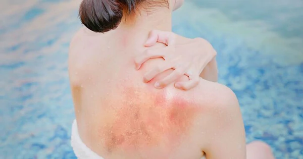 Házi praktikák leégésre: okosan, lehet!