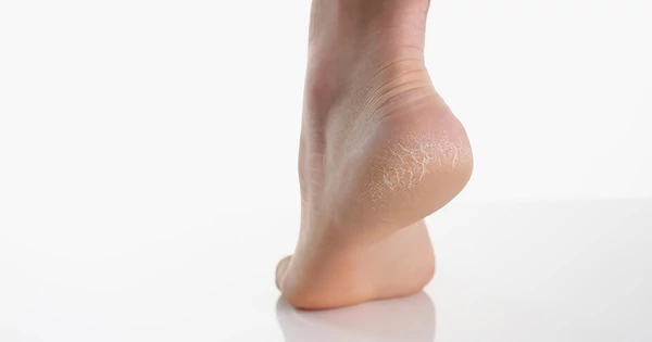 A száraz és repedezett sarok kezelése természetesen